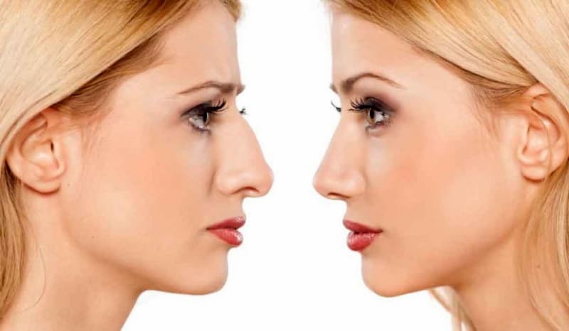 فيلر الانف | تجميل الانف بالفيلر | فيلر الانف قبل وبعد اخصائية الجراحة التجميلية | الدكتورة ليلى آرفاس فيلر الانف فيلر الانف ليلى ارفاس اسطنبول (1)