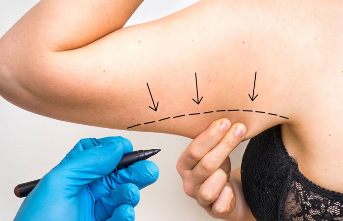 عملية شد الذراعين | ترهلات الذراعين اخصائية الجراحة التجميلية | الدكتورة ليلى آرفاس عملية شد الذراعين عملية شد الذراعين | ترهلات الذراعين اخصائية الجراحة التجميلية | الدكتورة ليلى آرفاس عملية شد الذراعين