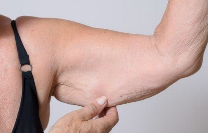 عملية شد الذراعين | ترهلات الذراعين اخصائية الجراحة التجميلية | الدكتورة ليلى آرفاس عملية شد الذراعين عملية شد الذراعين | ترهلات الذراعين اخصائية الجراحة التجميلية | الدكتورة ليلى آرفاس عملية شد الذراعين
