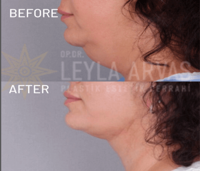 شفط دهون الذقن المزدوج اخصائية الجراحة التجميلية | الدكتورة ليلى آرفاس شفط دهون الذقن المزدوج شفط دهون الذقن المزدوج اخصائية الجراحة التجميلية | الدكتورة ليلى آرفاس شفط دهون الذقن المزدوج