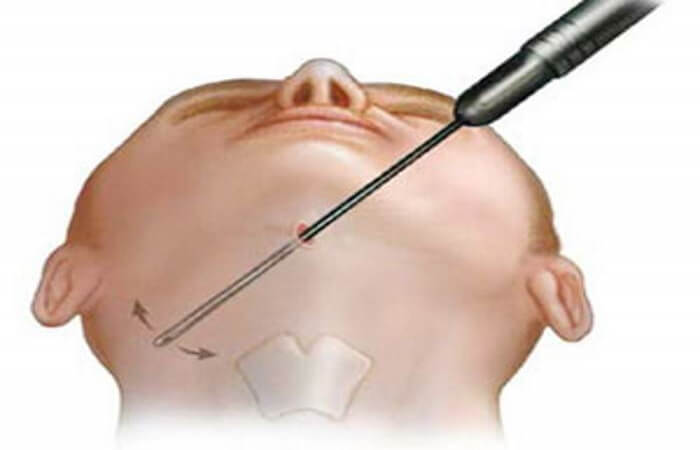 شفط دهون الذقن المزدوج اخصائية الجراحة التجميلية | الدكتورة ليلى آرفاس شفط دهون الذقن المزدوج شفط دهون الذقن المزدوج اخصائية الجراحة التجميلية | الدكتورة ليلى آرفاس شفط دهون الذقن المزدوج