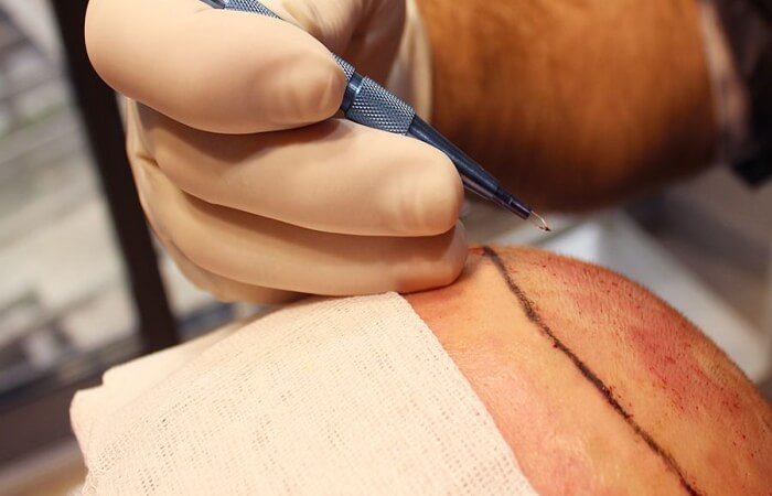 قلم السفير لزراعة الشعر اخصائية الجراحة التجميلية | الدكتورة ليلى آرفاس قلم السفير لزراعة الشعر قلم السفير لزراعة الشعر اخصائية الجراحة التجميلية | الدكتورة ليلى آرفاس قلم السفير لزراعة الشعر