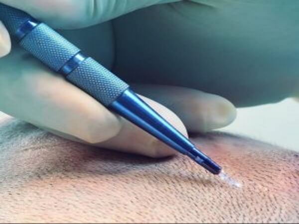 قلم السفير لزراعة الشعر اخصائية الجراحة التجميلية | الدكتورة ليلى آرفاس قلم السفير لزراعة الشعر قلم السفير لزراعة الشعر اخصائية الجراحة التجميلية | الدكتورة ليلى آرفاس قلم السفير لزراعة الشعر